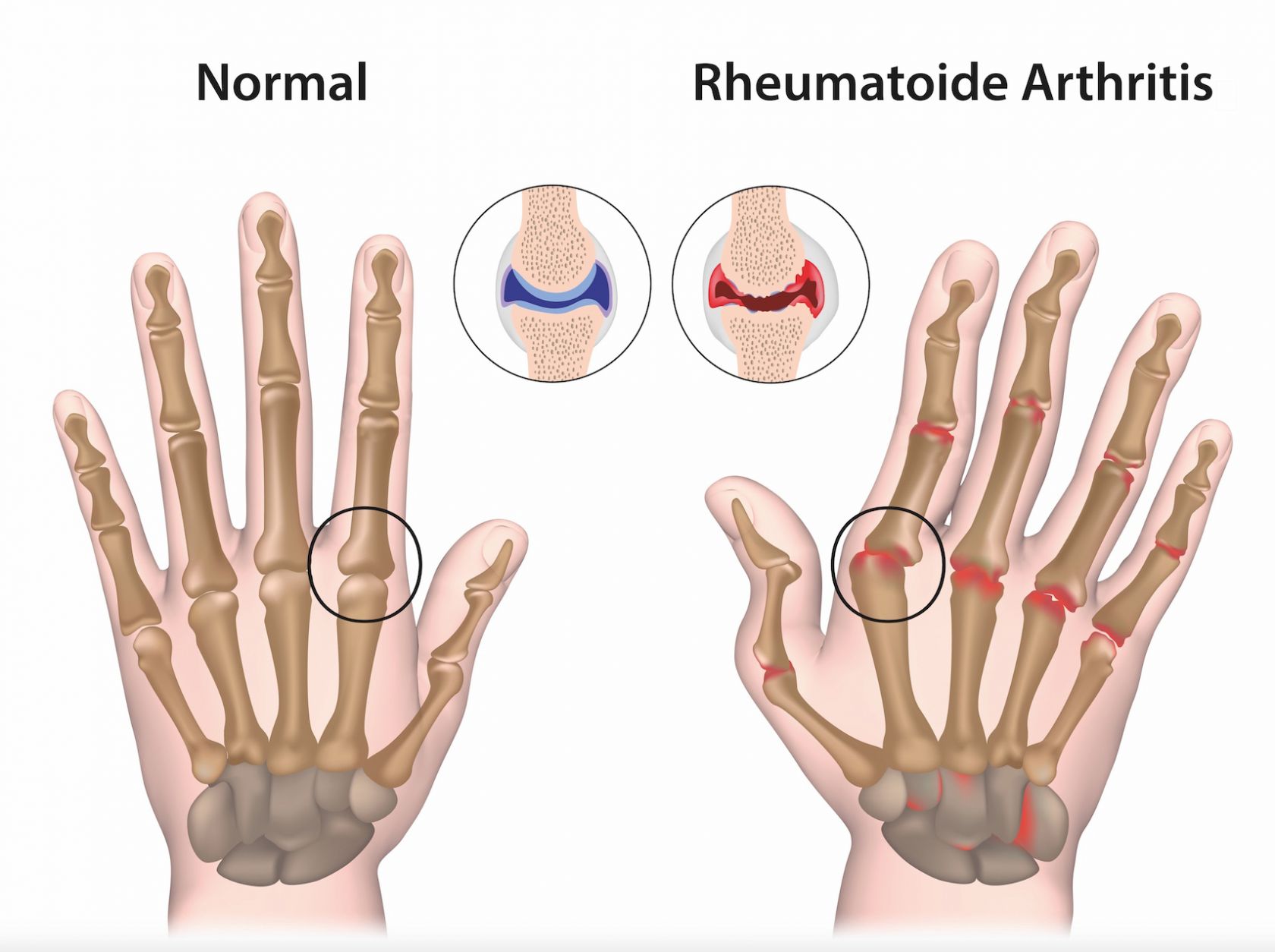 Abbildung rheumatoide Arthritis